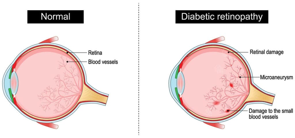 Chart illustrating a normal eye vs one with diabetic retinopathy